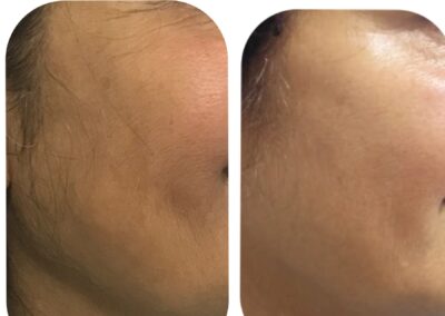 Face lift and skin tightening achieved by thread lift of face