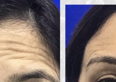 Botox for forehead lines