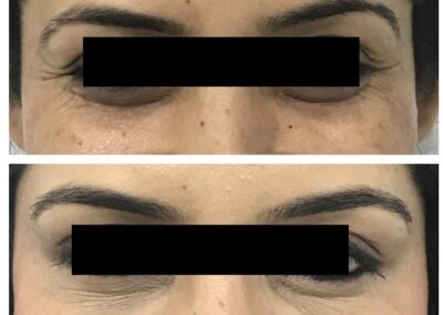 Botox for crows feet wrinkles