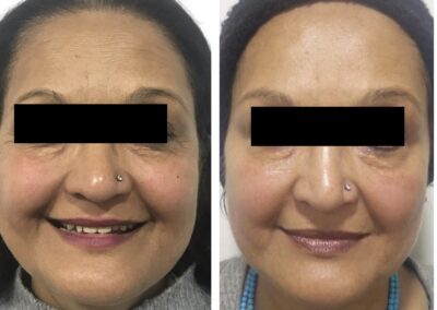 Face lift with fillers and threads