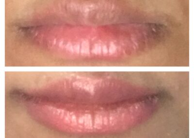 Lip plumping with fillers