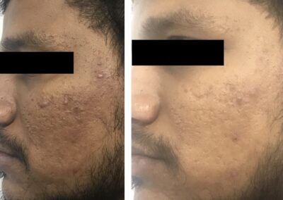 Microneedling radiofrequency treatment for acne scars