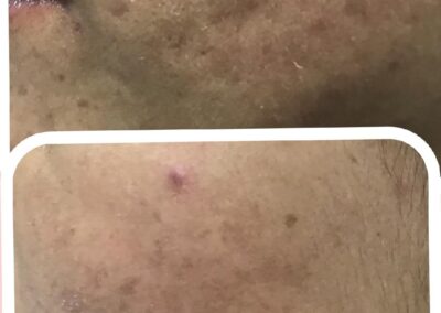 Acne scar treatment with co2 Laser