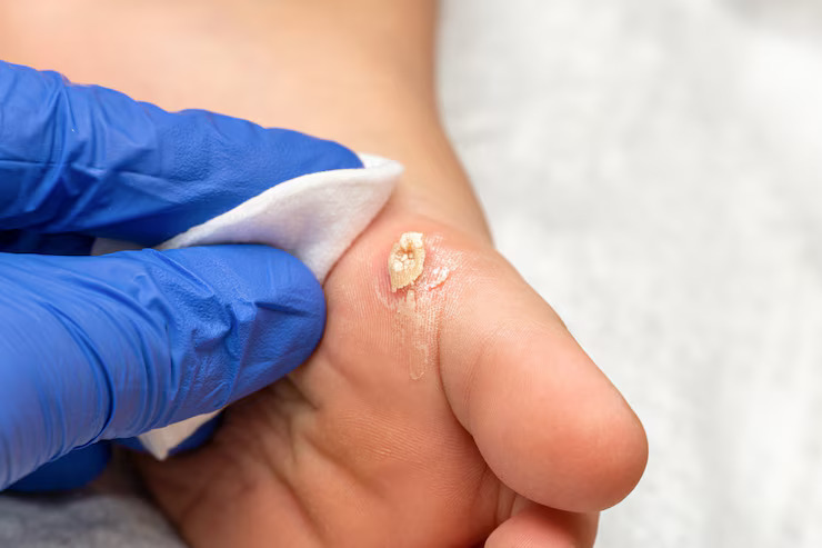 wart-removal-img