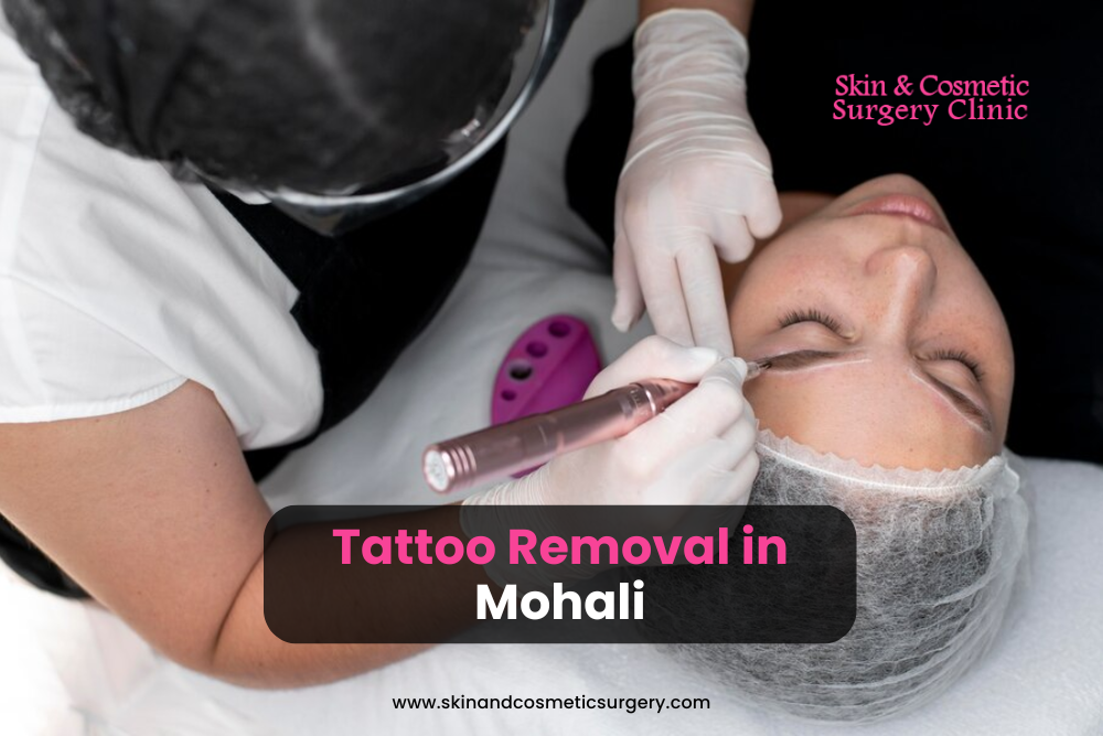 The Art of Tattoo removal in Mohali: How, where, and Why Professional Services