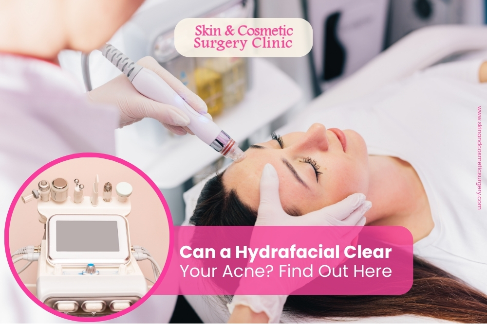 Can a Hydrafacial Clear Your Acne? Find Out Here