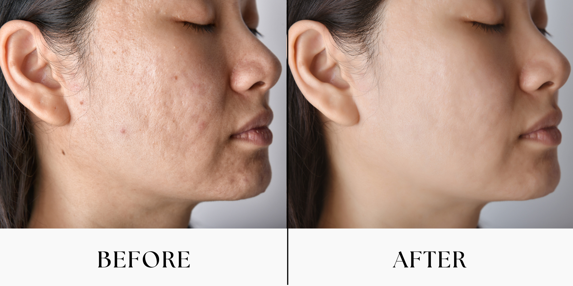 results skin-treatment