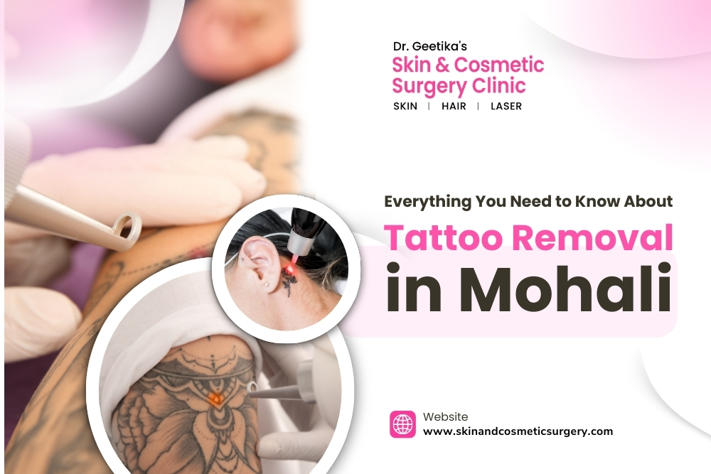 Everything You Need to Know About Tattoo Removal in Mohali