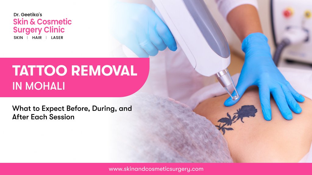 Tattoo Removal in Mohali: What to Expect Before, During, and After Each Session